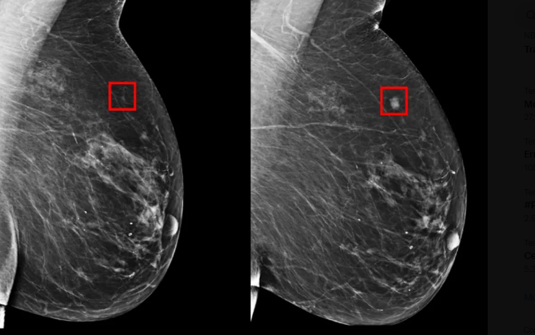 La inteligencia artificial puede detectar el cáncer de mama 5 años antes de que se desarrolle