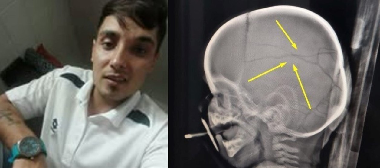 Liberaron a un golpeador de niños y reincidió: le fracturó el cráneo a un bebé